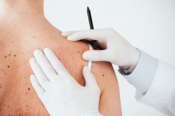geniki_kliniki_melanoma_